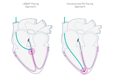 Physiologic Pacing with LBBAP